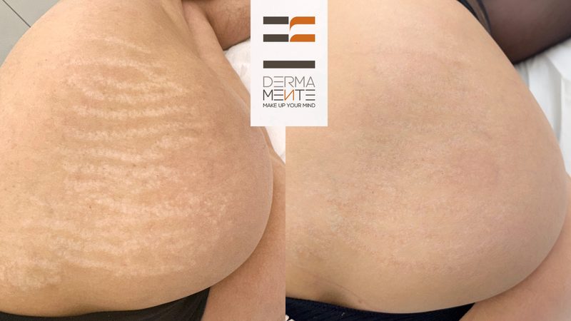 Areola mammaria tatuaggio paramedicale Roma