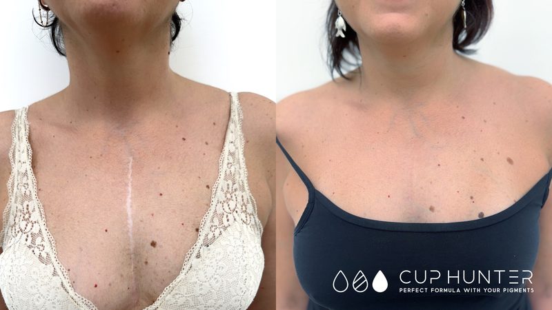 Camouflage cicatrici dermopigmentazione Roma