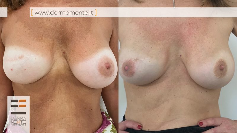 Camouflage cicatrici dermopigmentazione Roma