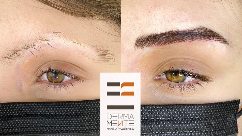 Cicatrici trucco permanente copertura Roma