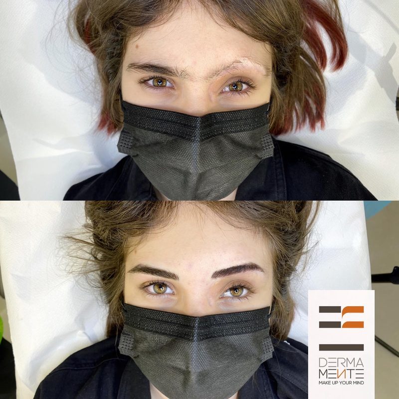 Copertura cicatrici con dermopigmentazione Roma