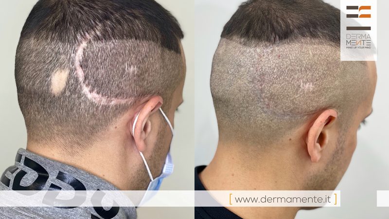 Copertura vitiligine dermopigmentazione Roma