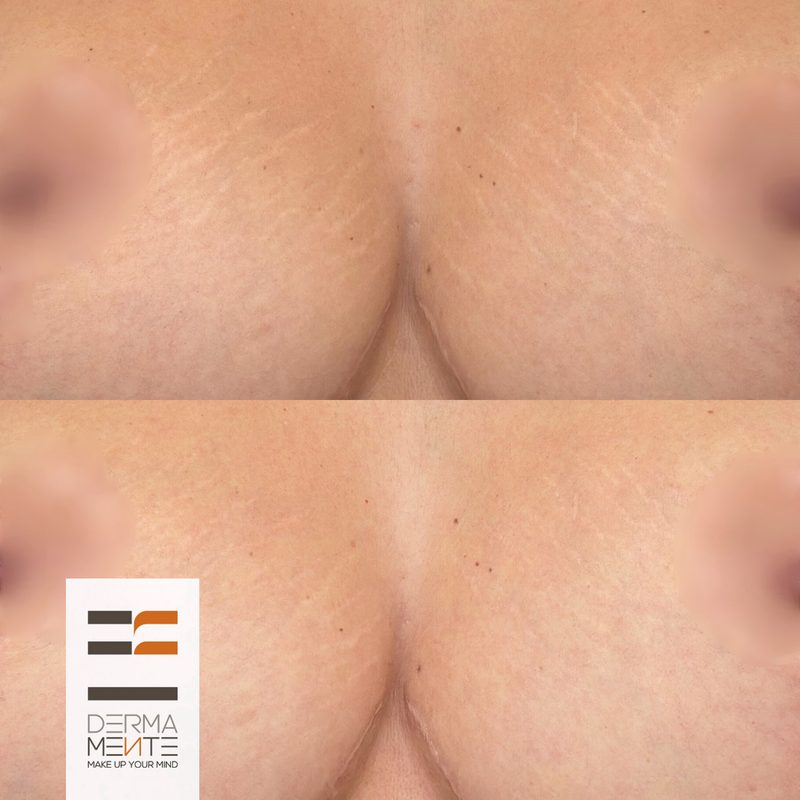 Copertura vitiligine dermopigmentazione Roma