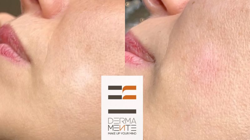 Dermopigmentazione medicale Roma