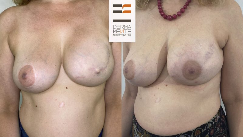 Ricostruzione areola mammaria Roma