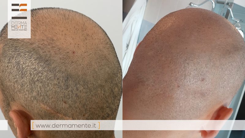 Micropigmentazione cuoio capelluto Roma