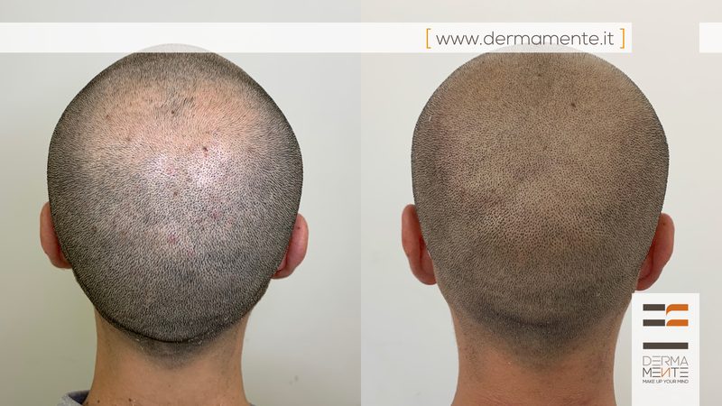 Scalp micropigmentation Roma