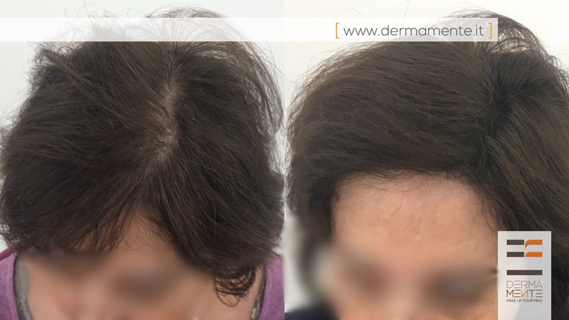 Tricopigmentazione calvizie Roma