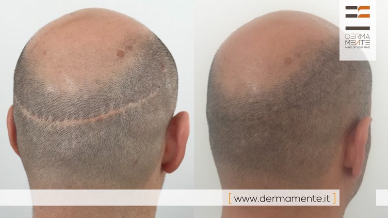 Tricopigmentazione diradamento capelli Roma