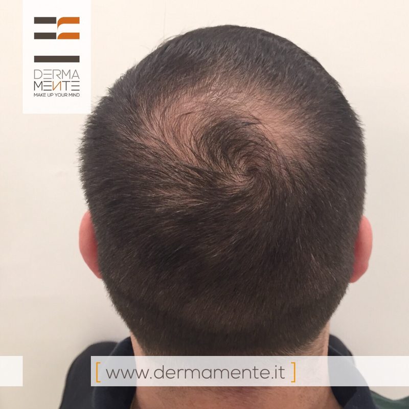 Tricopigmentazione diradamento capelli Roma