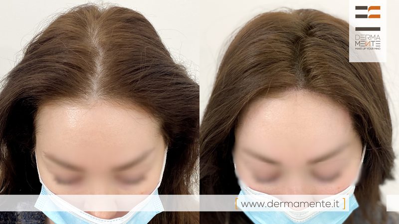 Tricopigmentazione diradamento capelli Roma