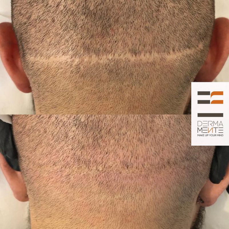 Tricopigmentazione donna Roma