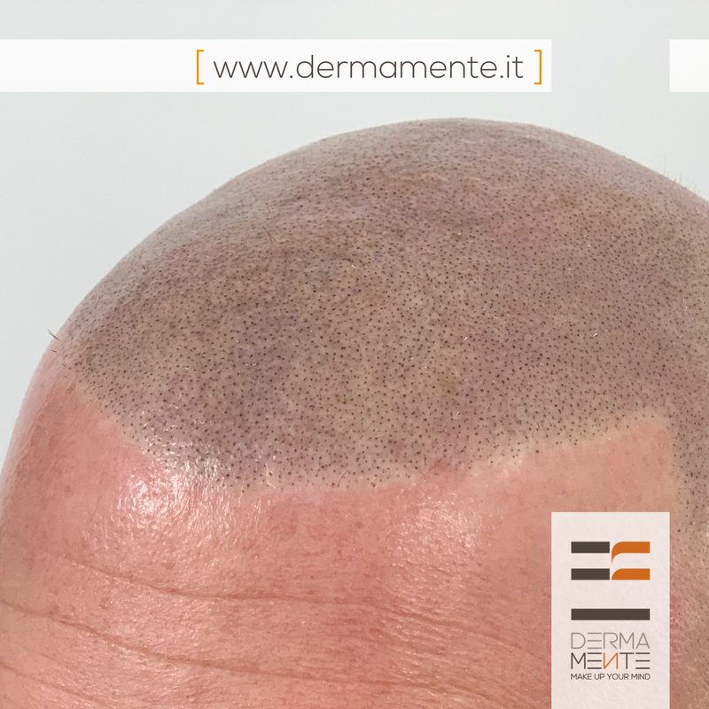 Tricopigmentazione donna Roma