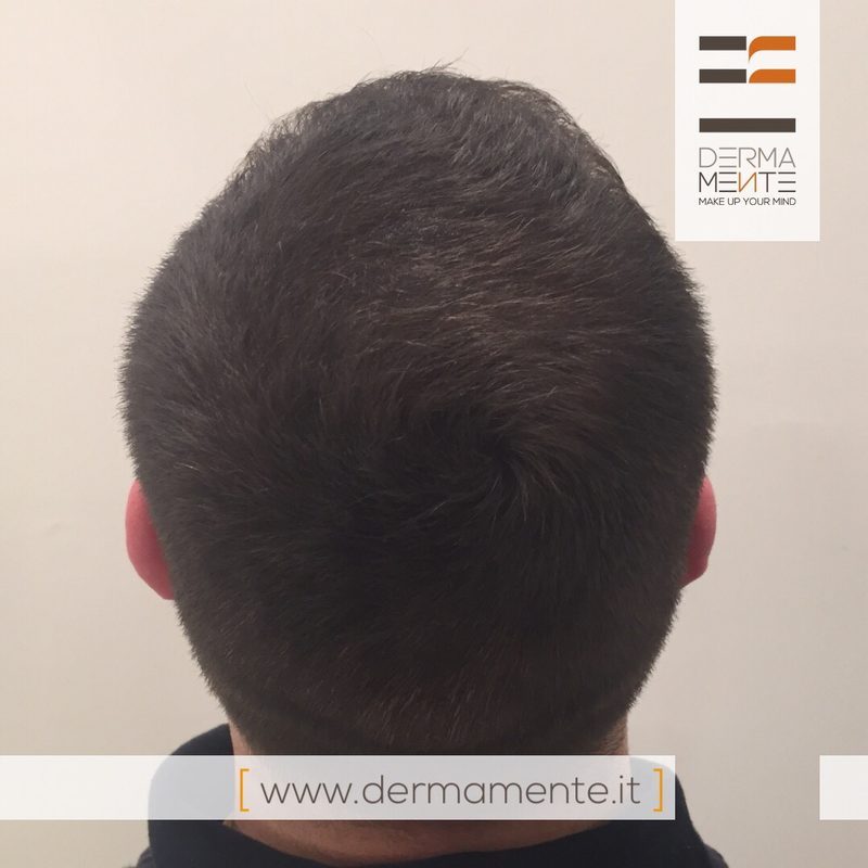 Tricopigmentazione risultato prima e dopo Roma