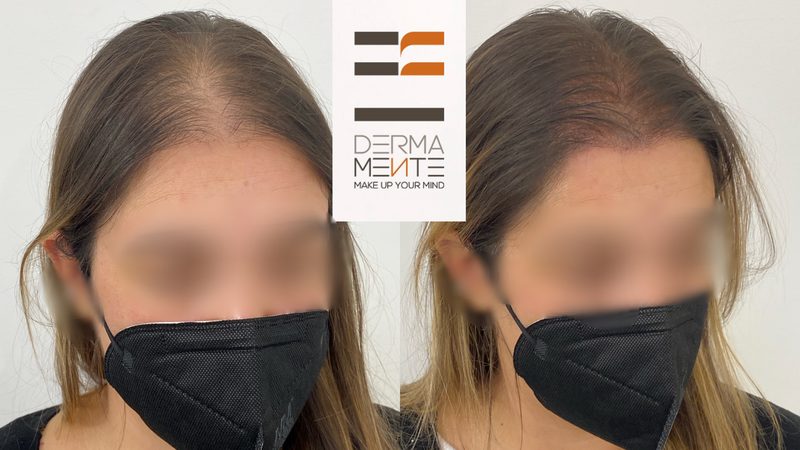 Tricopigmentazione risultati Roma