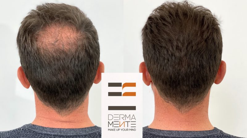 Tricopigmentazione prima e dopo Roma