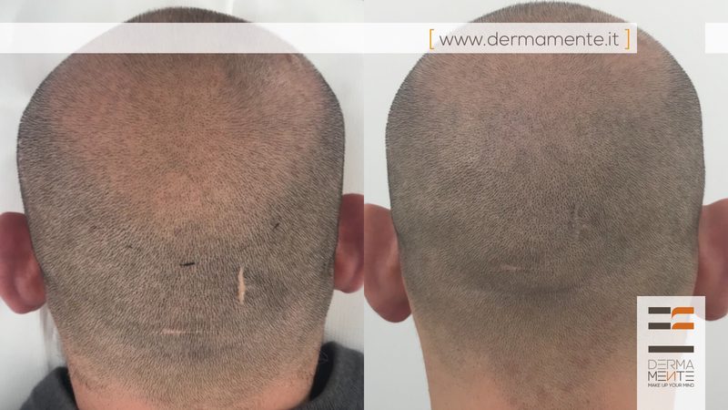 Tricopigmentazione prima e dopo Roma