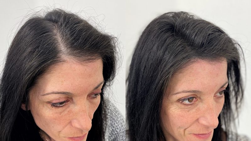 Tricopigmentazione prima e dopo Roma