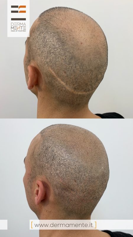 Tricopigmentazione stempiatura Roma